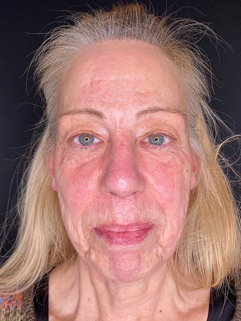 Facelift Before & After Gallery - Patient 143359 - Image 3