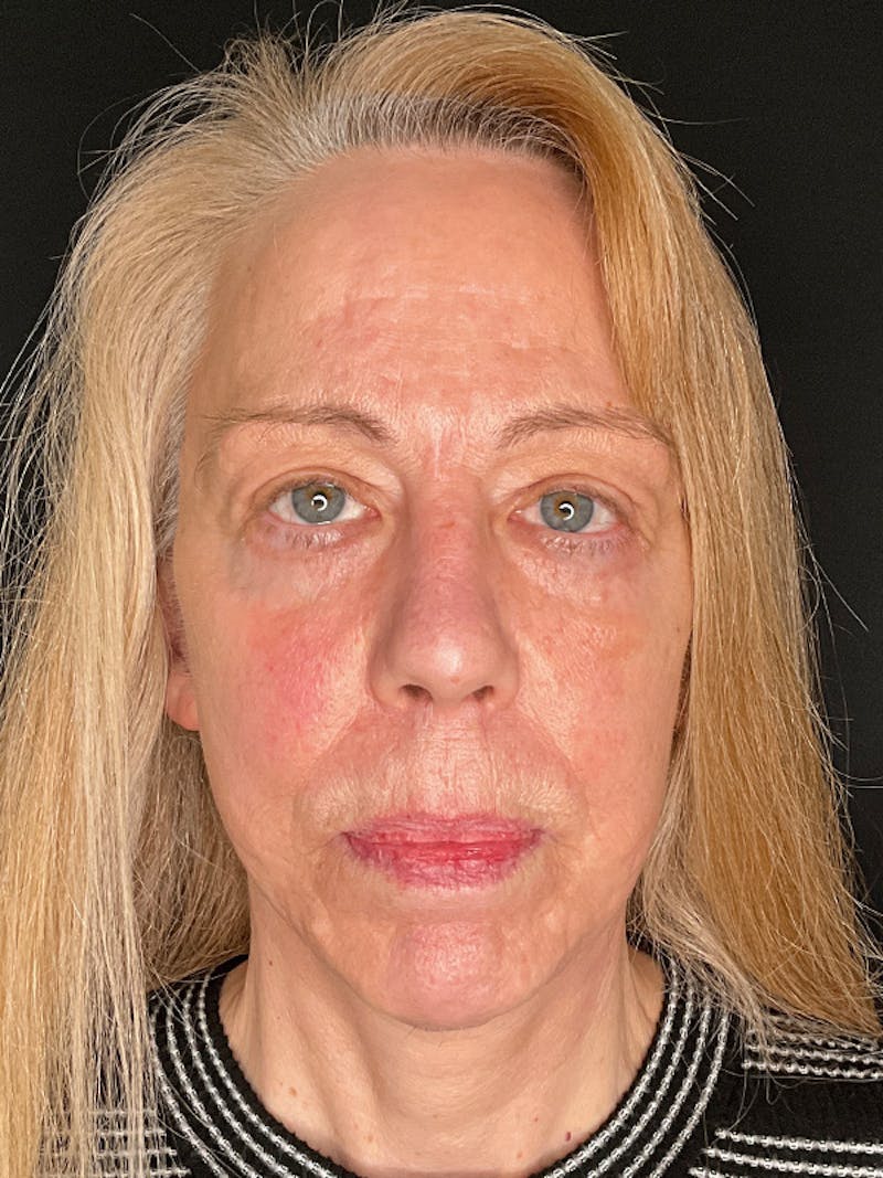 Facelift Before & After Gallery - Patient 143359 - Image 4