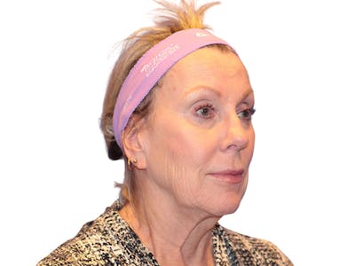 Facelift Before & After Gallery - Patient 234675 - Image 1