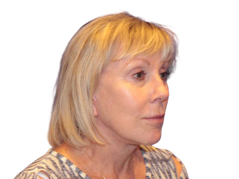 Facelift Before & After Gallery - Patient 234675 - Image 2