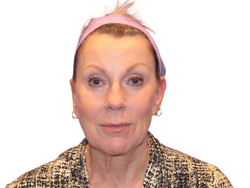 Facelift Before & After Gallery - Patient 234675 - Image 3