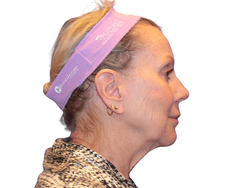 Facelift Before & After Gallery - Patient 234675 - Image 5