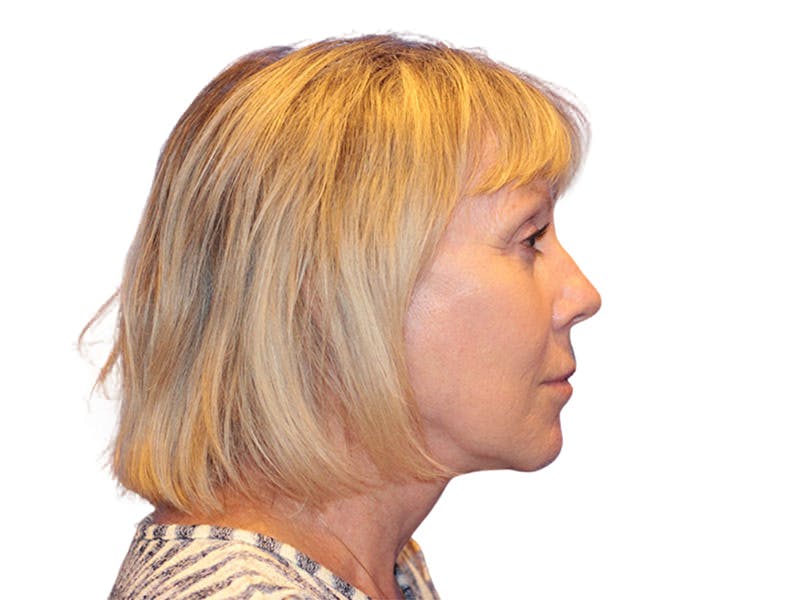 Facelift Before & After Gallery - Patient 234675 - Image 6