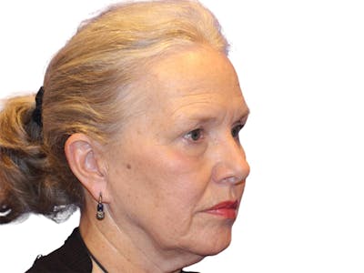 Facelift Before & After Gallery - Patient 184835 - Image 1