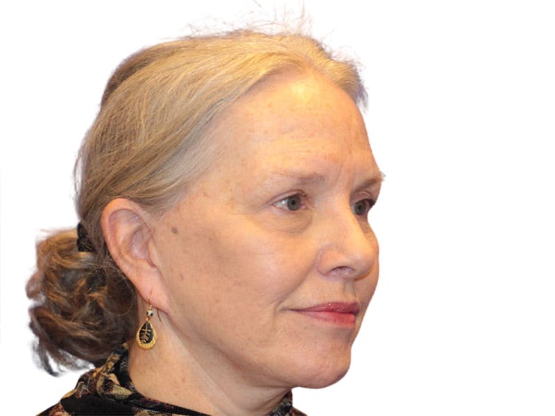 Facelift Before & After Gallery - Patient 184835 - Image 2