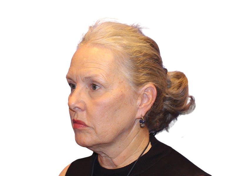 Facelift Before & After Gallery - Patient 184835 - Image 3