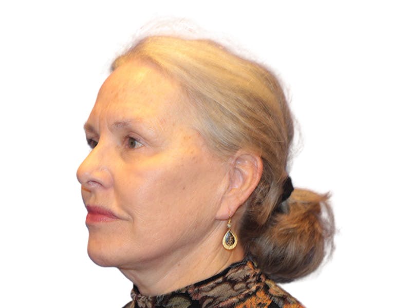 Facelift Before & After Gallery - Patient 184835 - Image 4