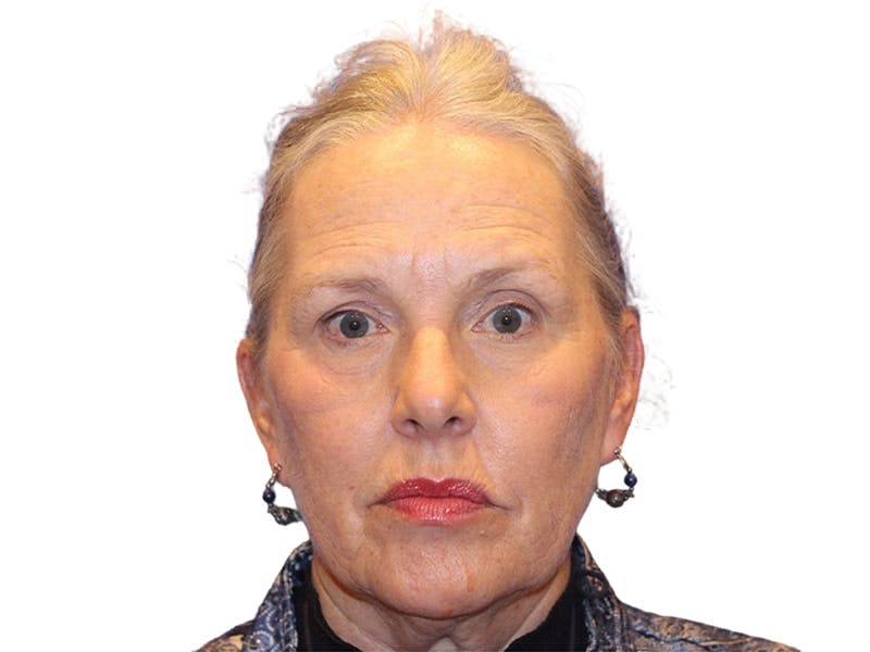 Facelift Before & After Gallery - Patient 184835 - Image 5