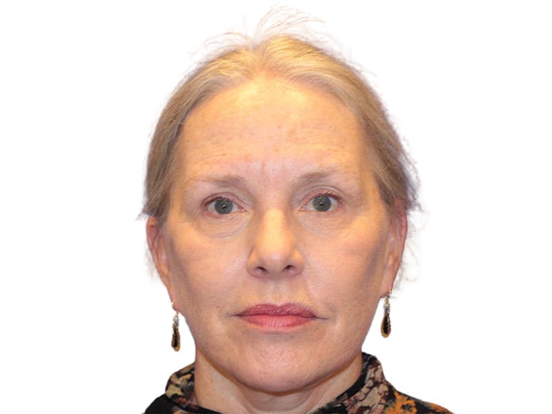 Facelift Before & After Gallery - Patient 184835 - Image 6