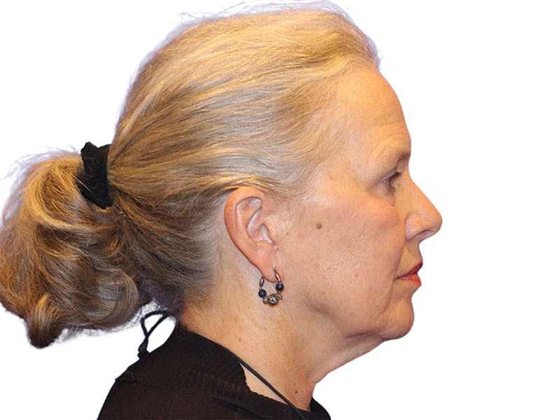 Facelift Before & After Gallery - Patient 184835 - Image 7