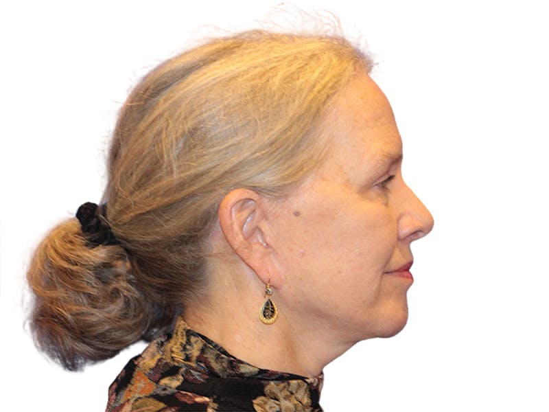 Facelift Before & After Gallery - Patient 184835 - Image 8