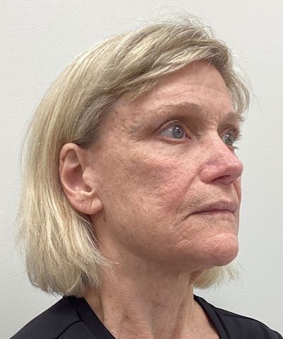 Facelift Before & After Gallery - Patient 183509 - Image 1