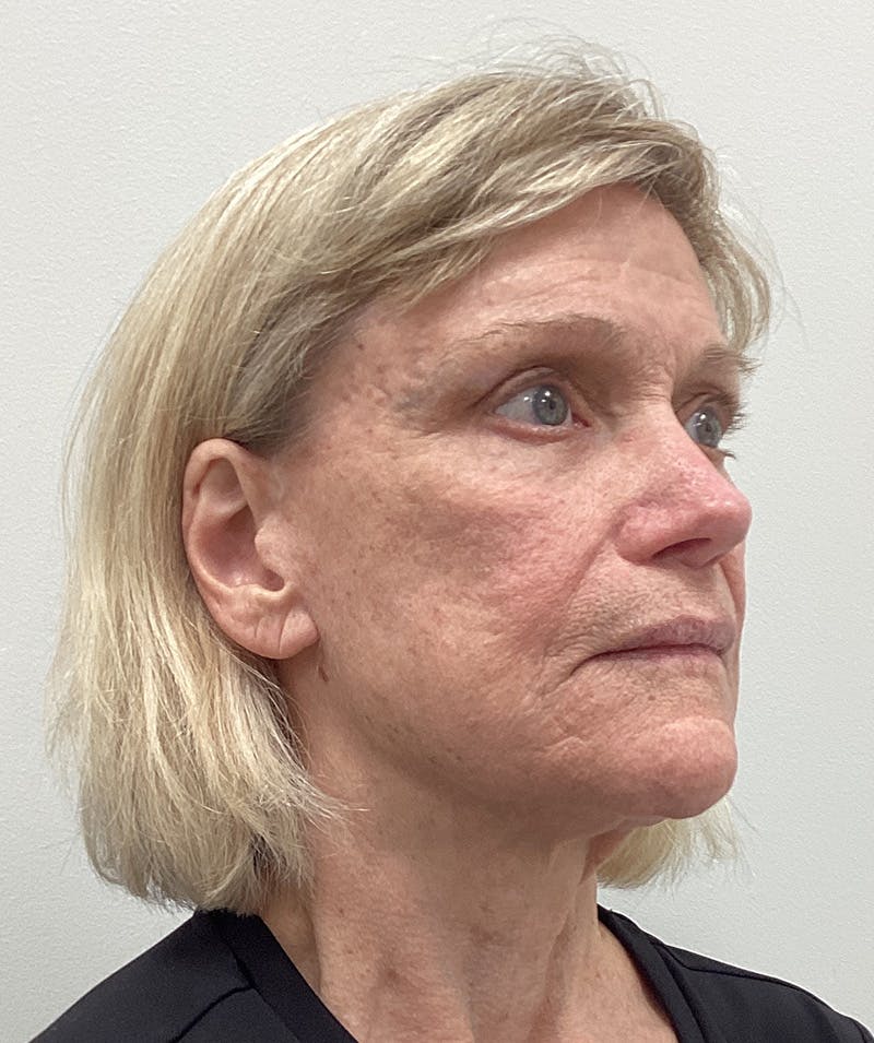 Facelift Before & After Gallery - Patient 183509 - Image 1
