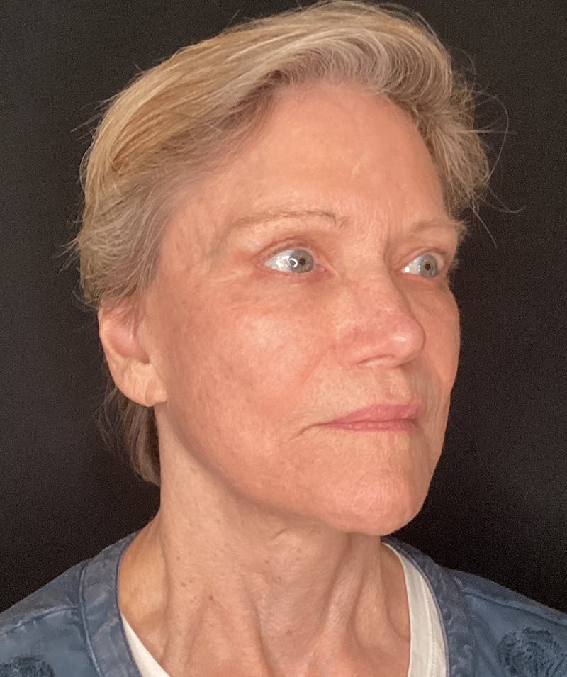Facelift Before & After Gallery - Patient 183509 - Image 2