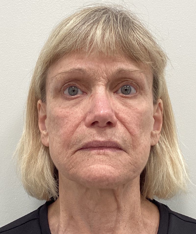 Facelift Before & After Gallery - Patient 183509 - Image 3