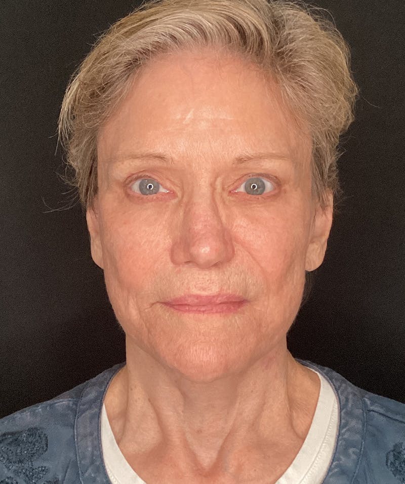 Facelift Before & After Gallery - Patient 183509 - Image 4