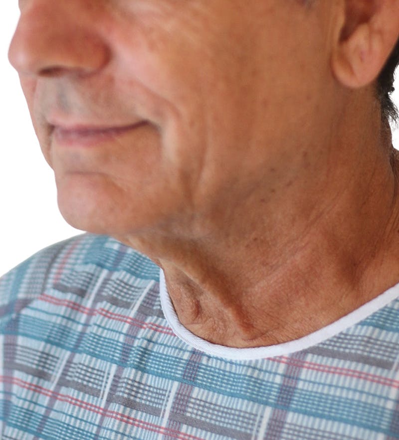 Facelift Before & After Gallery - Patient 160545 - Image 1