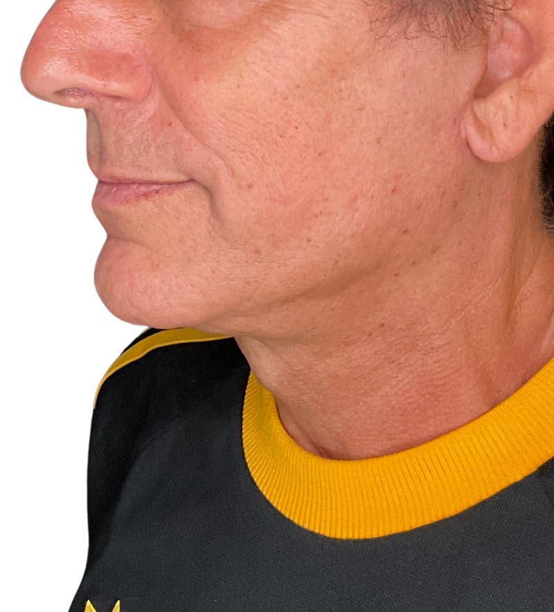 Facelift Before & After Gallery - Patient 160545 - Image 2