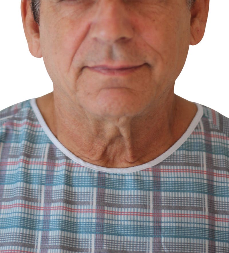 Facelift Before & After Gallery - Patient 160545 - Image 3