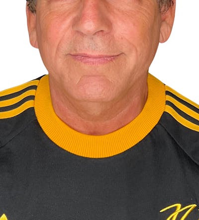 Facial Fat Grafting Before & After Gallery - Patient 223204 - Image 2