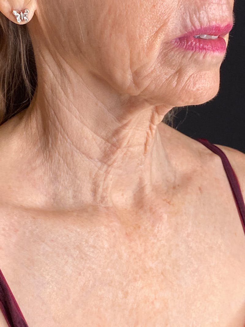 Neck Lift Before & After Gallery - Patient 301715 - Image 1