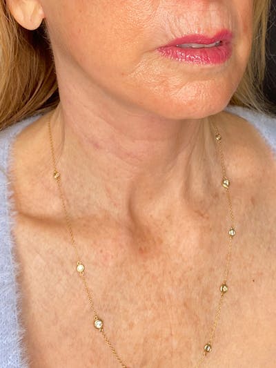 Facelift Before & After Gallery - Patient 307297 - Image 2