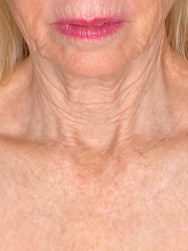 Neck Lift Before & After Gallery - Patient 301715 - Image 3