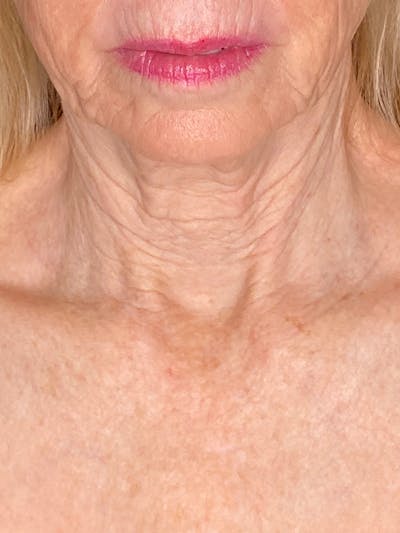 Skin Transformation Before & After Gallery - Patient 253824 - Image 1