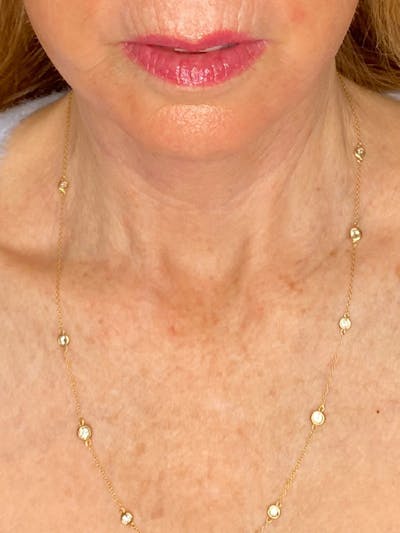Skin Transformation Before & After Gallery - Patient 253824 - Image 2