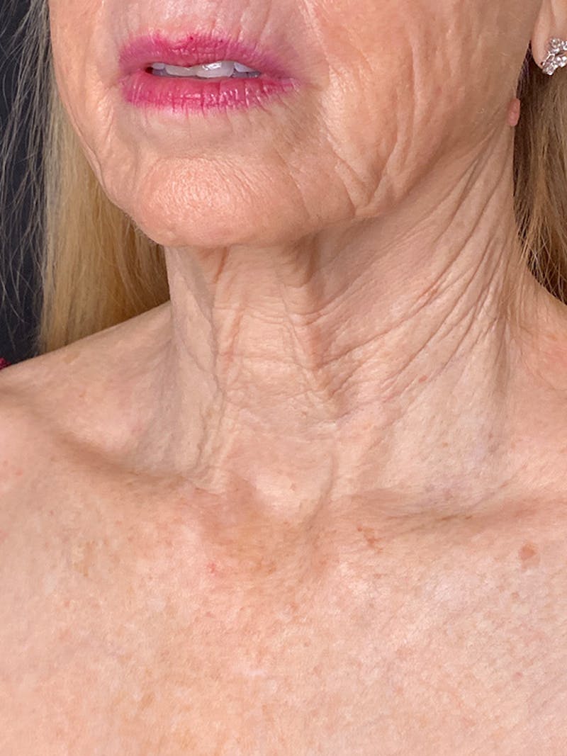 Neck Lift Before & After Gallery - Patient 301715 - Image 5