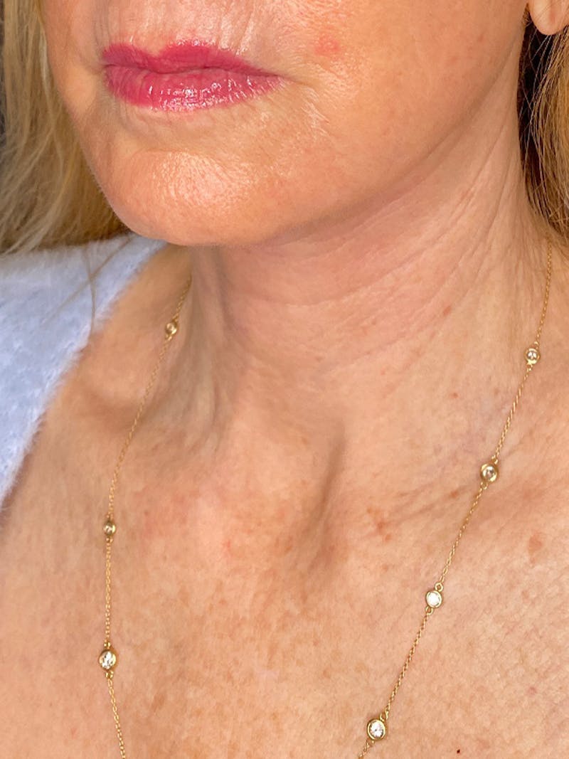 Neck Lift Before & After Gallery - Patient 301715 - Image 6
