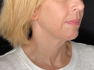 Facelift Before & After Gallery - Patient 177288 - Image 1