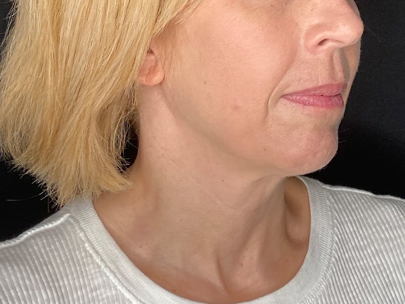 Facelift Before & After Gallery - Patient 177288 - Image 1