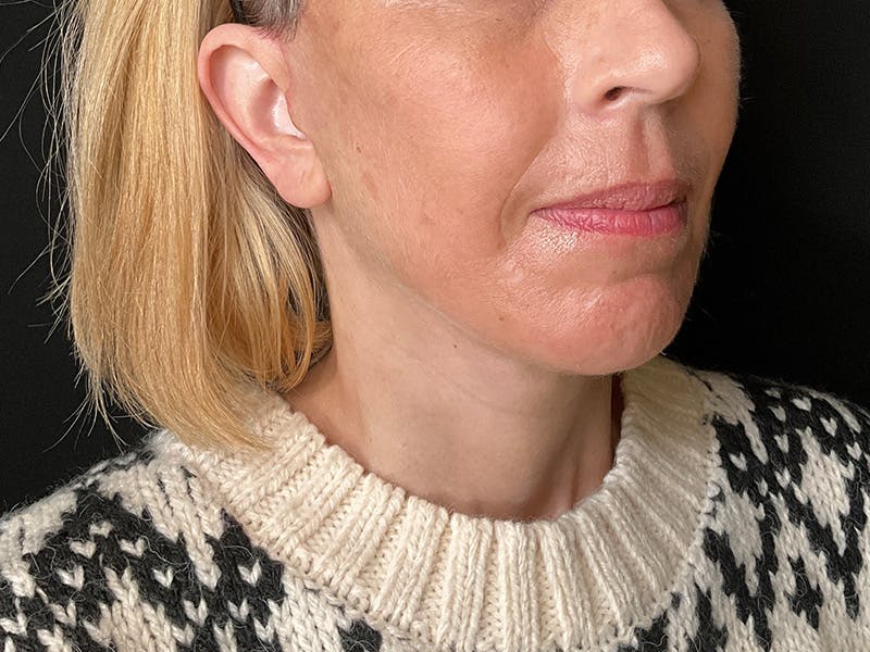 Facelift Before & After Gallery - Patient 177288 - Image 2