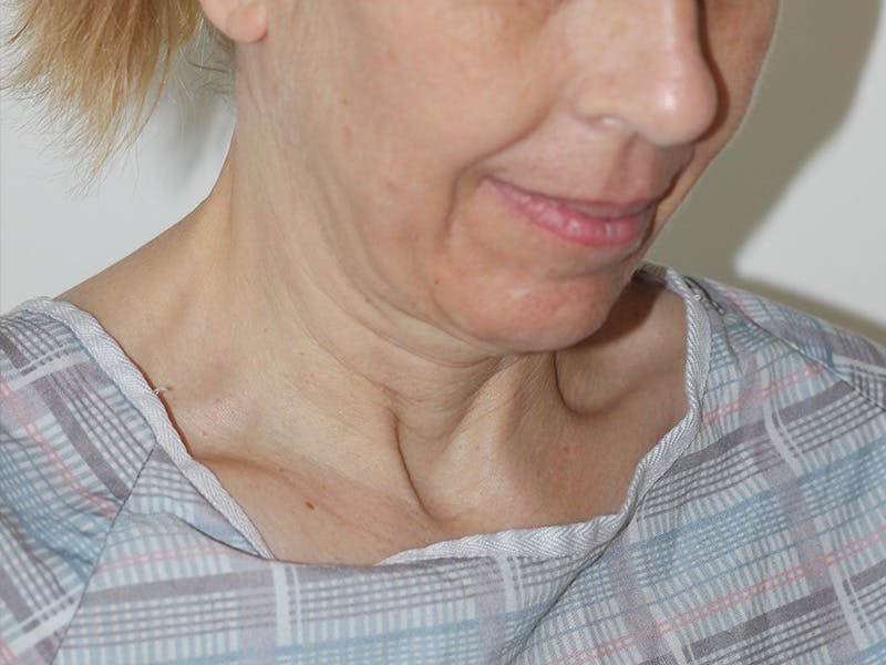 Facelift Before & After Gallery - Patient 177288 - Image 3