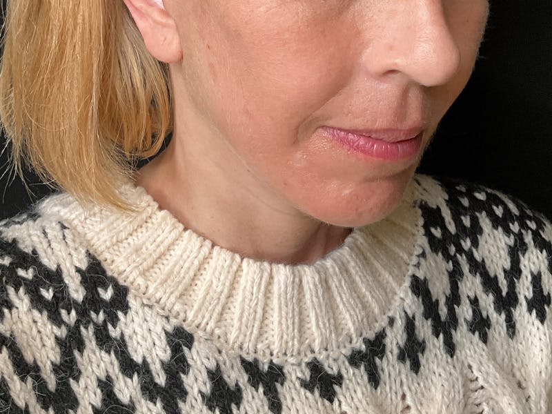 Facelift Before & After Gallery - Patient 177288 - Image 4