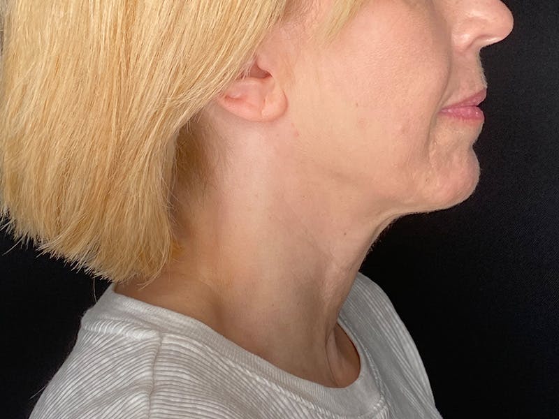 Facelift Before & After Gallery - Patient 177288 - Image 5