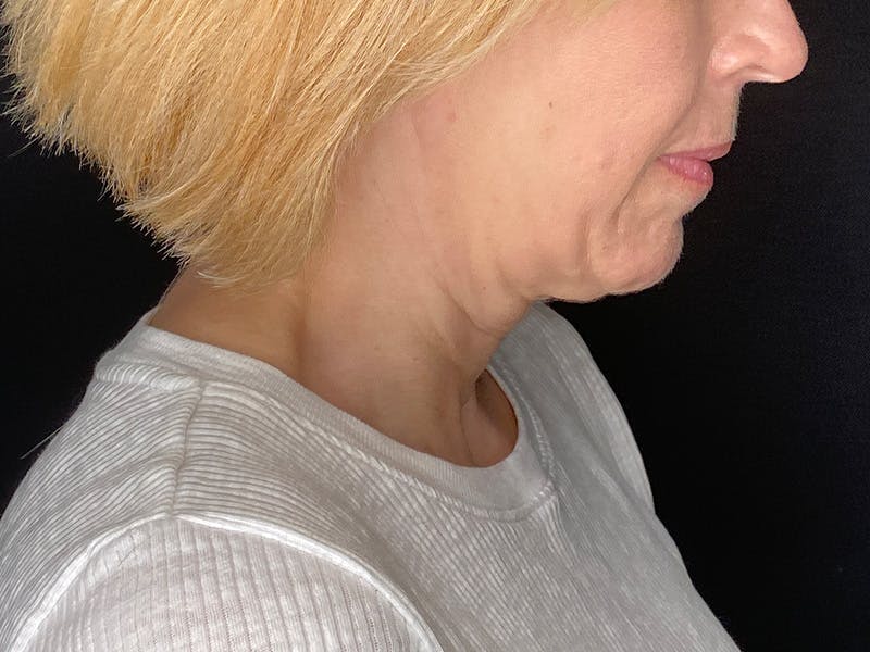 Facelift Before & After Gallery - Patient 177288 - Image 7