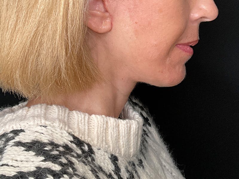 Facelift Before & After Gallery - Patient 177288 - Image 8