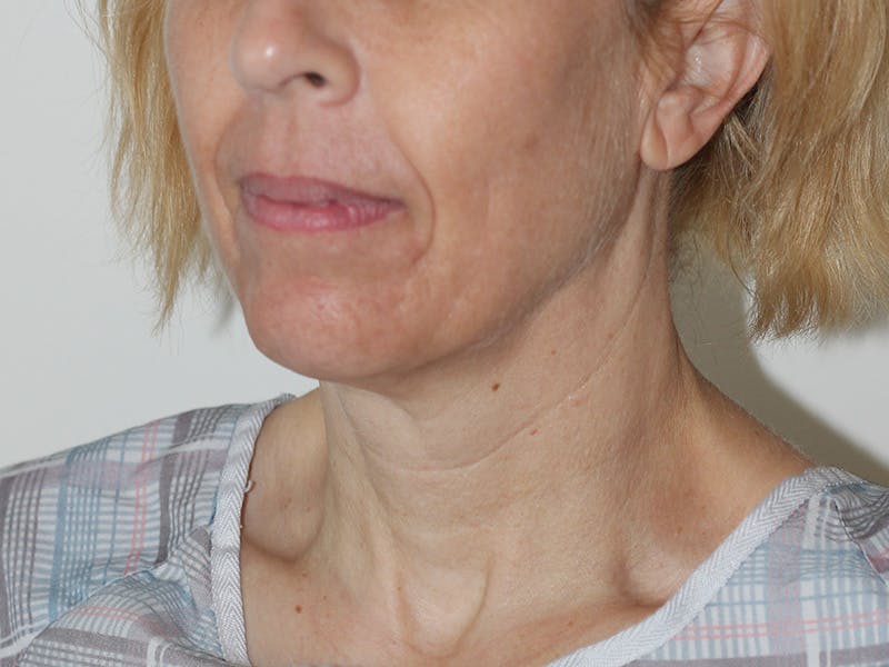 Facelift Before & After Gallery - Patient 177288 - Image 9