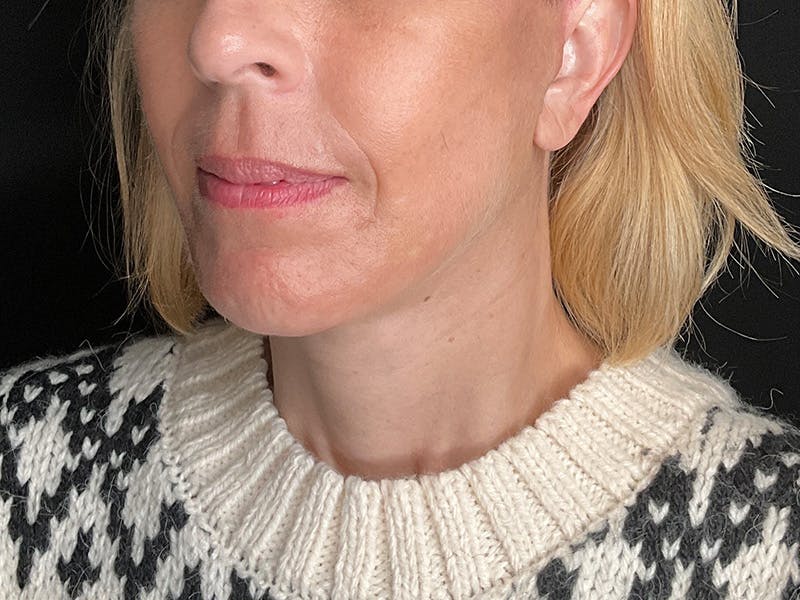 Facelift Before & After Gallery - Patient 177288 - Image 10