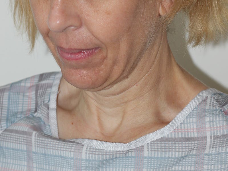 Facelift Before & After Gallery - Patient 177288 - Image 11