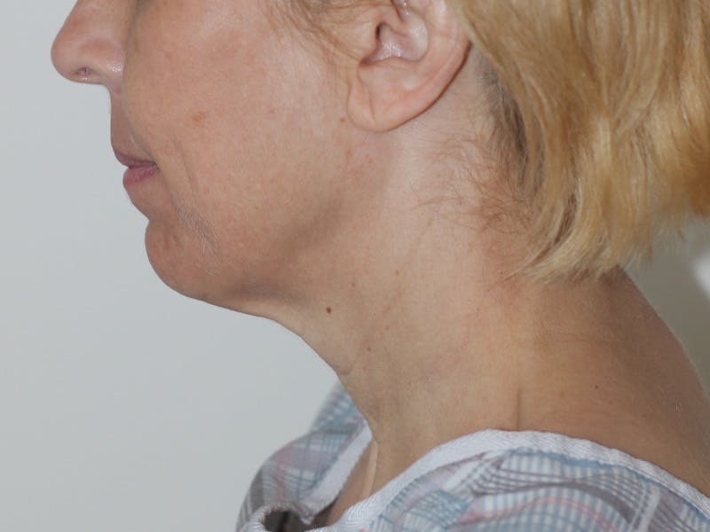 Facelift Before & After Gallery - Patient 177288 - Image 13