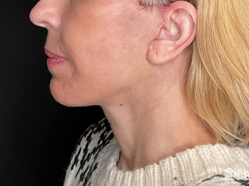 Facelift Before & After Gallery - Patient 177288 - Image 14