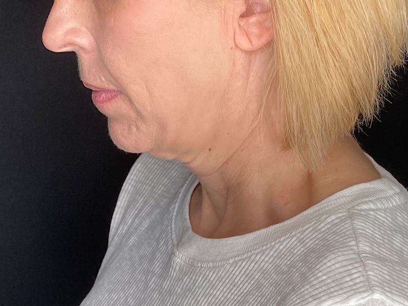 Facelift Before & After Gallery - Patient 177288 - Image 15