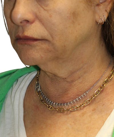 Facelift Before & After Gallery - Patient 293318 - Image 1