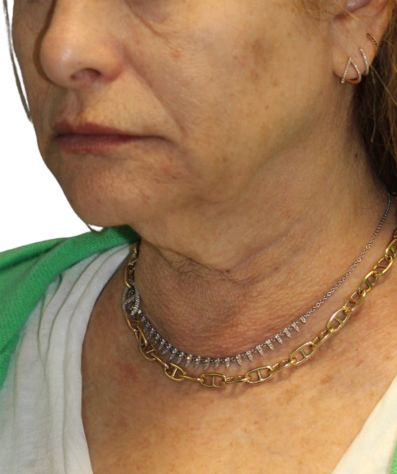 Facelift Before & After Gallery - Patient 293318 - Image 1