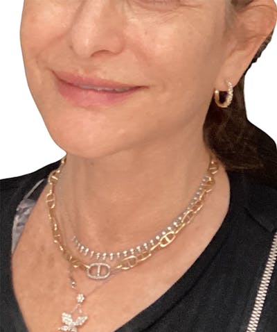 Facelift Before & After Gallery - Patient 293318 - Image 2