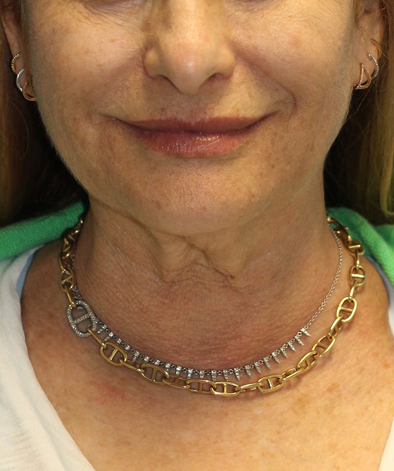 Facelift Before & After Gallery - Patient 293318 - Image 3