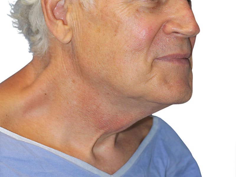 Facelift Before & After Gallery - Patient 134387 - Image 1